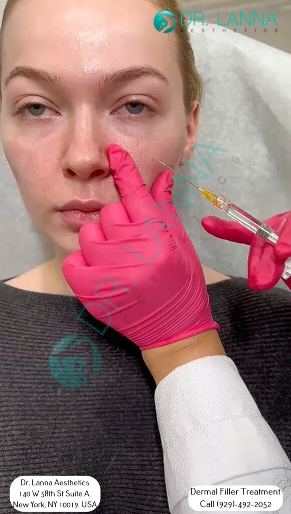 a woman who had cheek fillers at Dr. Lanna's clinic