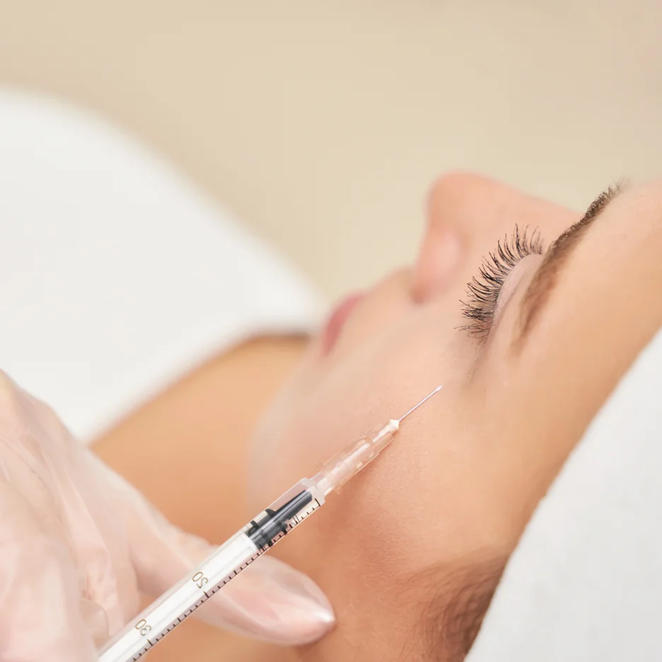 a woman received cheek fillers for under eye bags