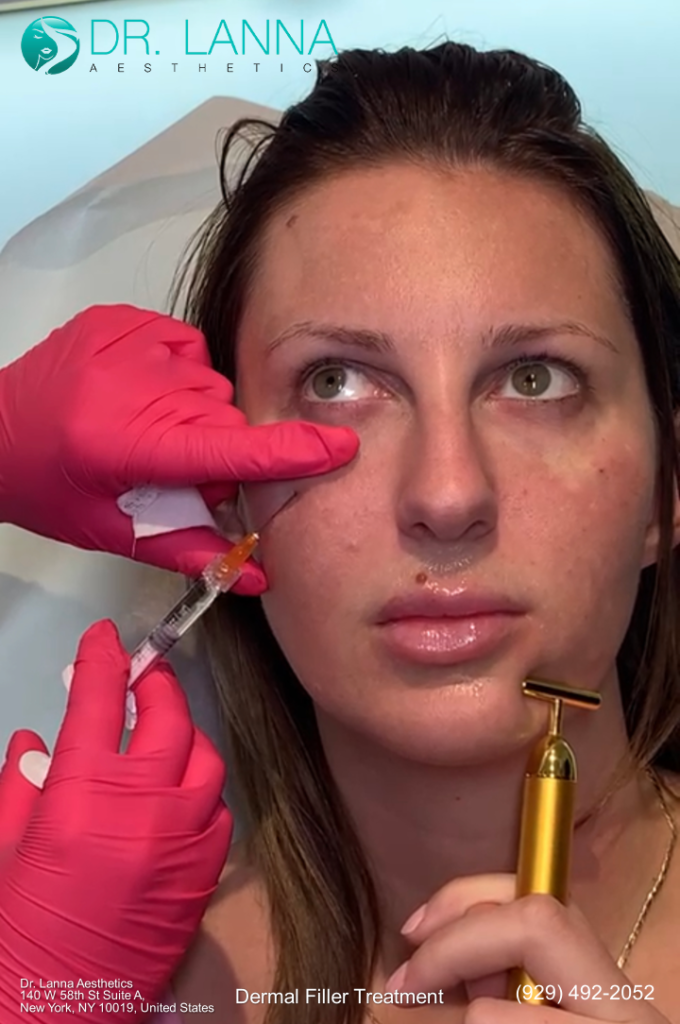 a woman received cheek fillers for her under eye bags at Dr. Lanna's clinic