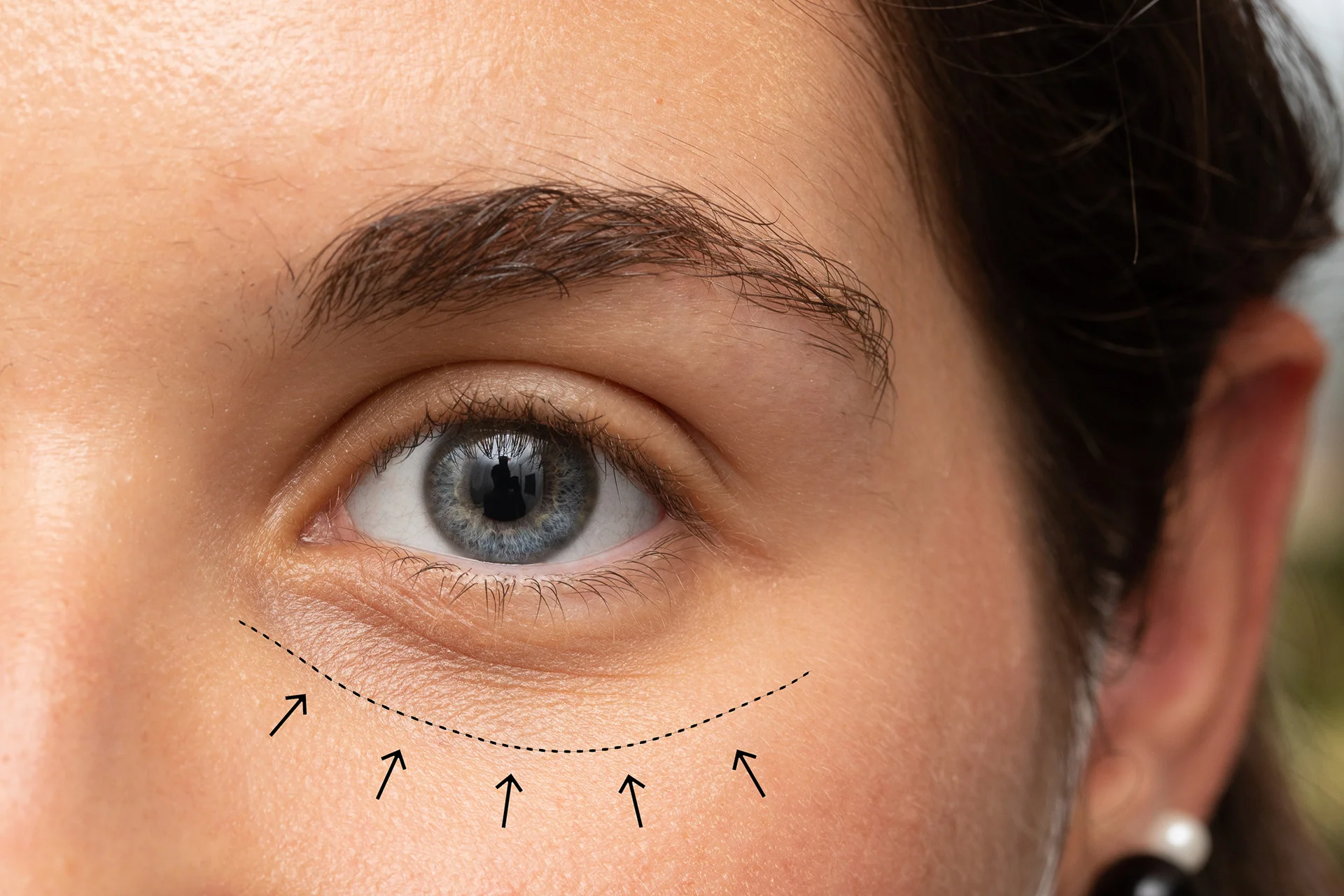 provider marked the under eye area of the patient for the cheek fillers to inject||a woman received cheek fillers for her under eye bags at Dr. Lanna's clinic