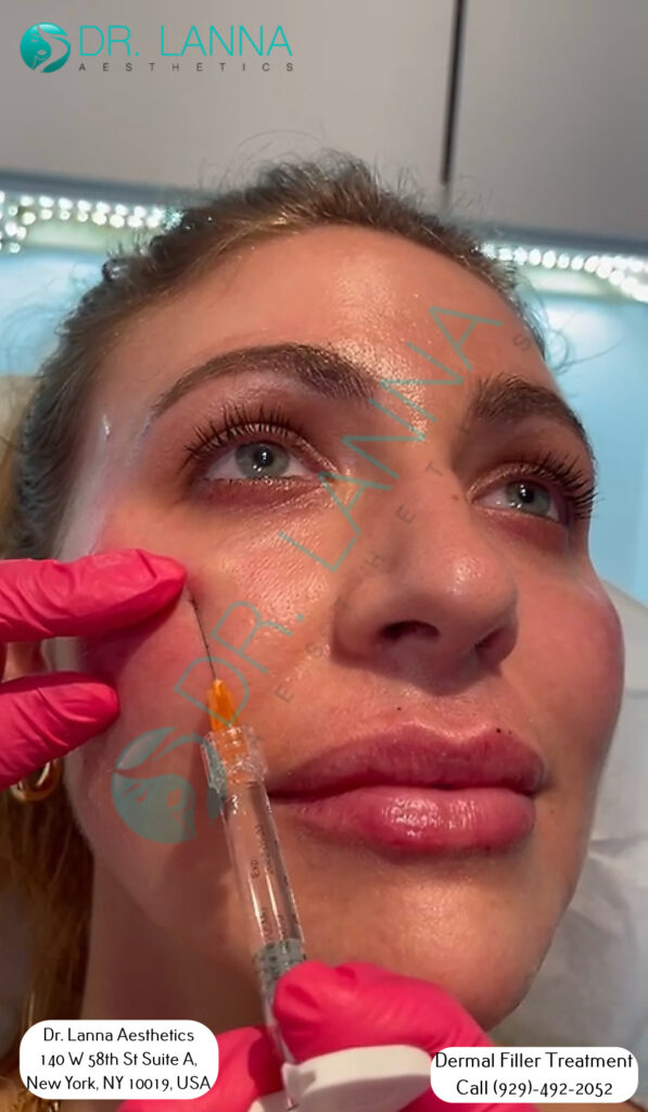 a woman had cheek filler treatment at Dr. Lanna's clinic