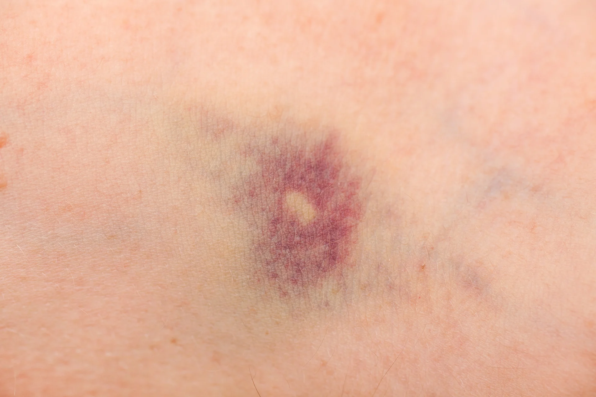 bruising skin||