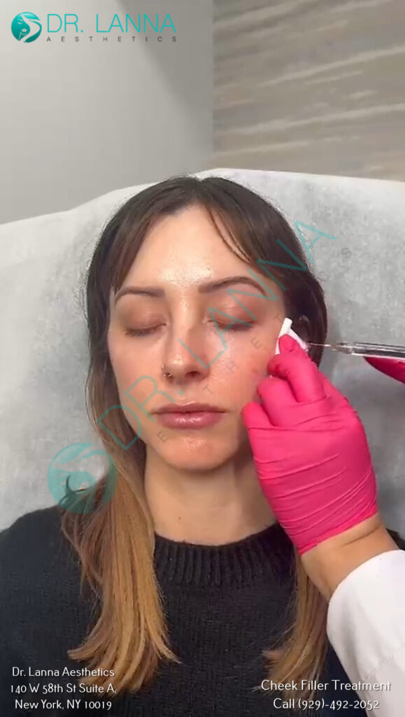a woman had cheek filler treatment at Dr. Lanna's clinic