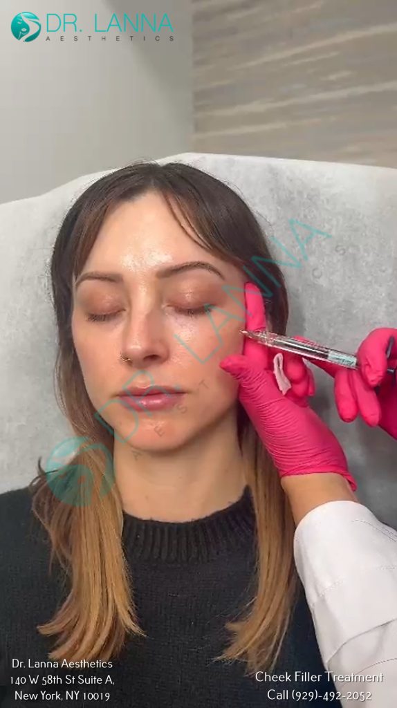 Cheek Filler Treatment at Dr. Lanna Aesthetics