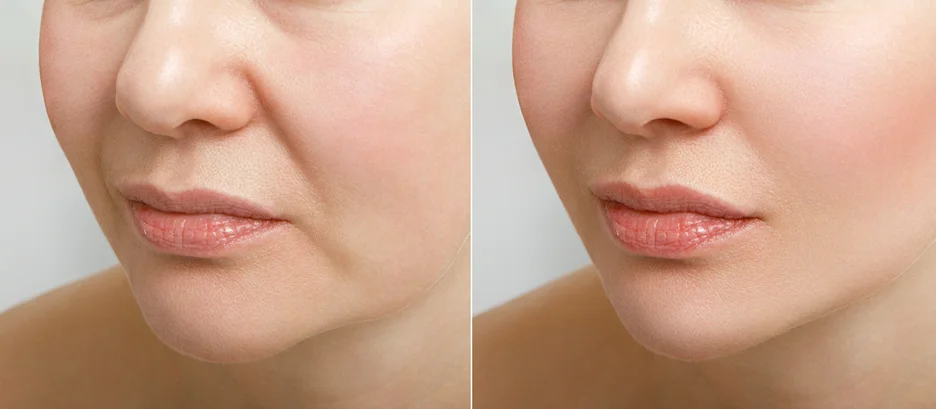 Before and After Cheek Filler