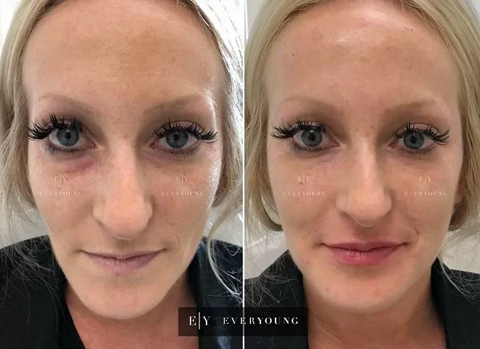 Before and after cheek filler result
