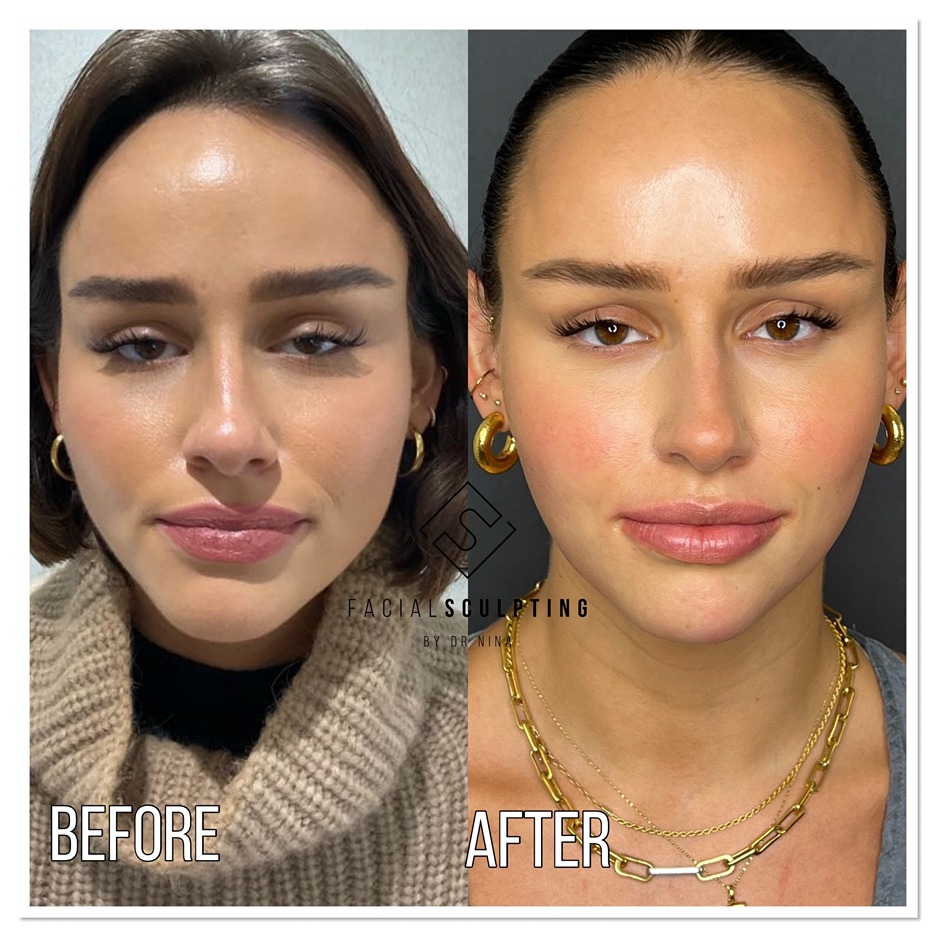 Before and after cheek filler result
