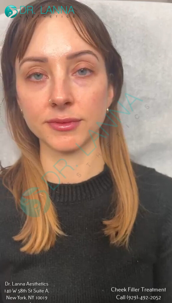 Cheek Filler Result