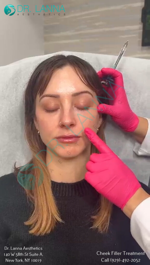 cheek filler results