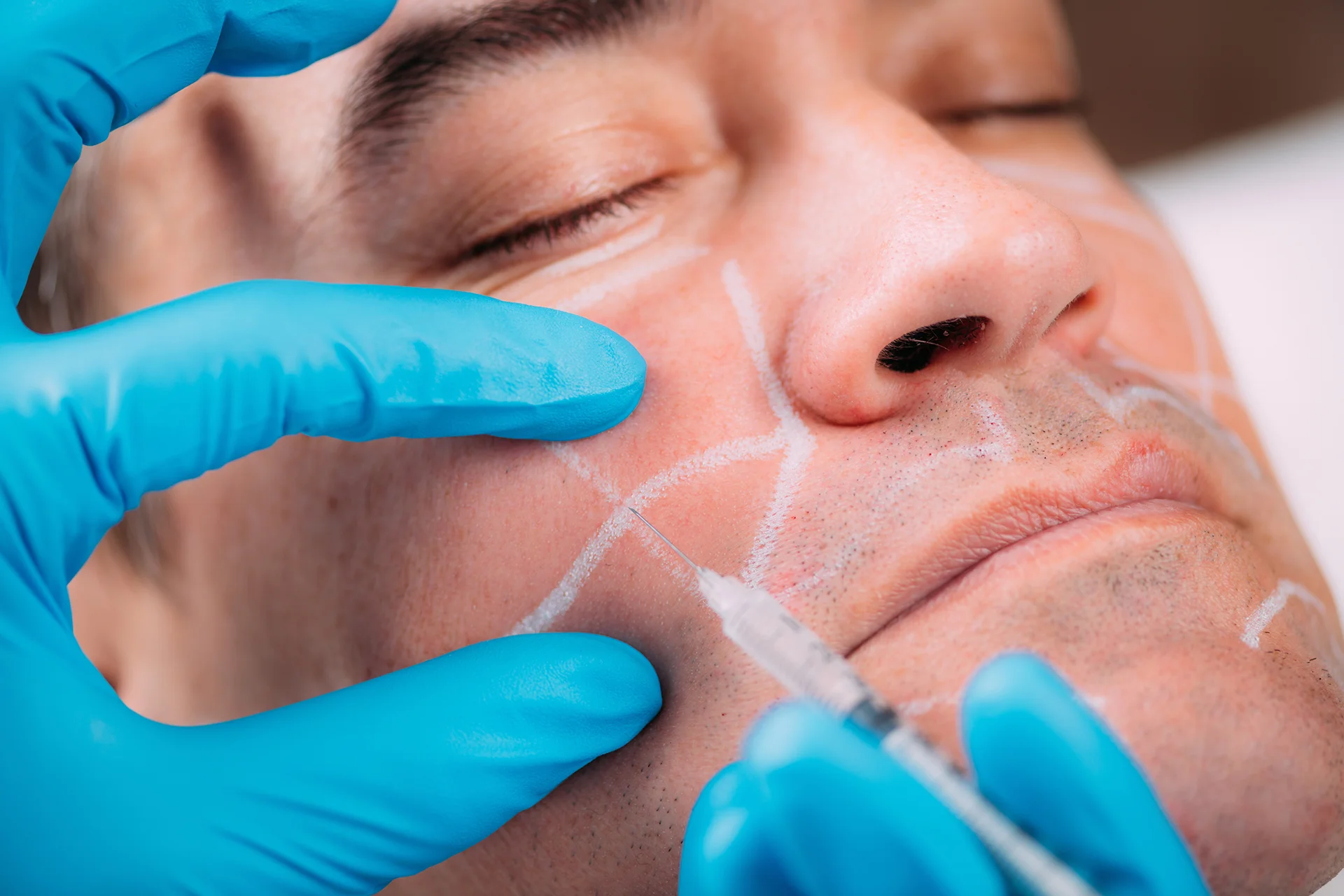 a man had cheek filler procedure in a beauty clinic||