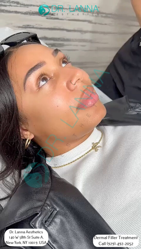a woman had cheek filler treatment at Dr. Lanna's clinic