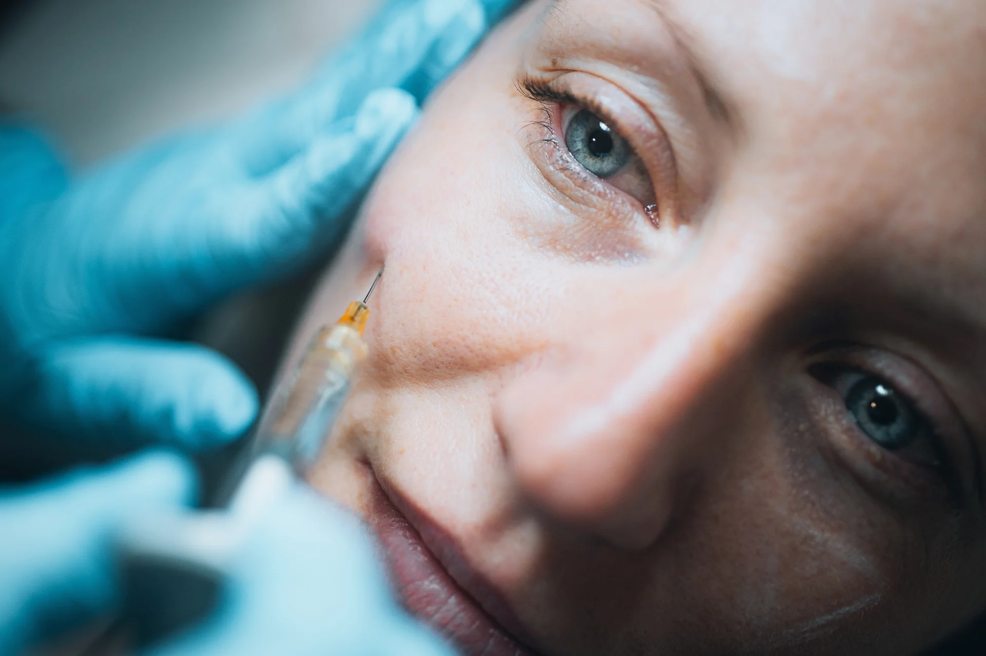 a woman received cheek filler injection||