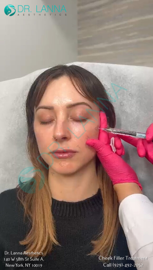 Client receiving a cheek filler injection at Dr. Lanna Aesthetics, NYC