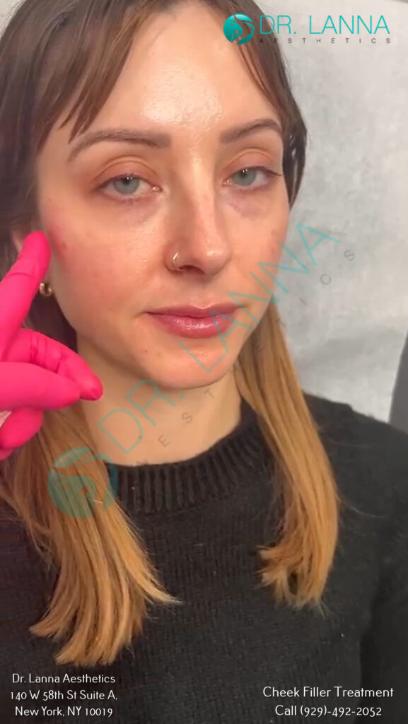 cheek filler results