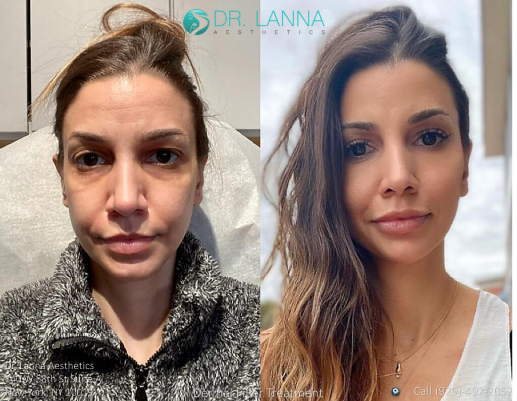 woman had cheek filler procedure in a beauty clinic
