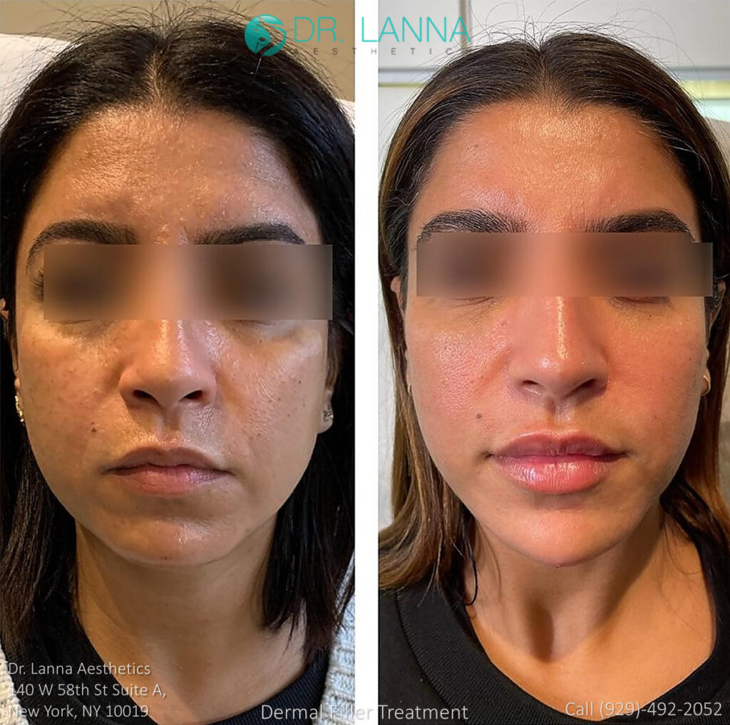 woman undergoes cheek fillers procedure