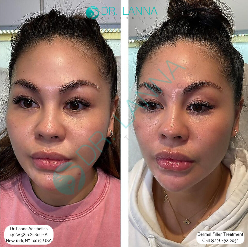 a woman had cheek filler injection at Dr. Lanna's clinic