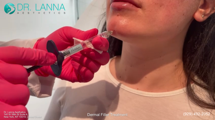 best chin filler type suitable to a woman's goal