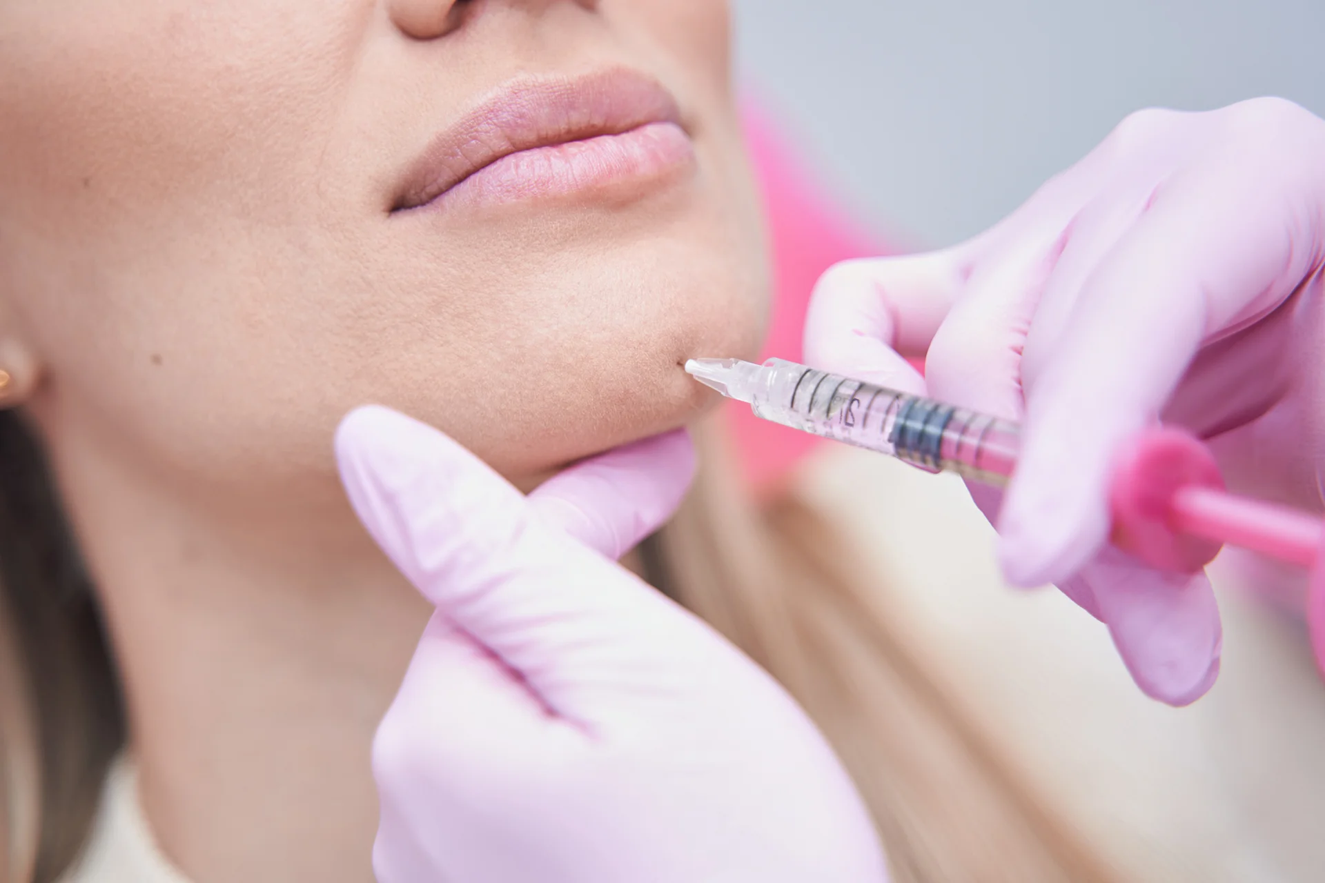 how often a woman can have chin fillers re-applicaation|woman has chin filler injections