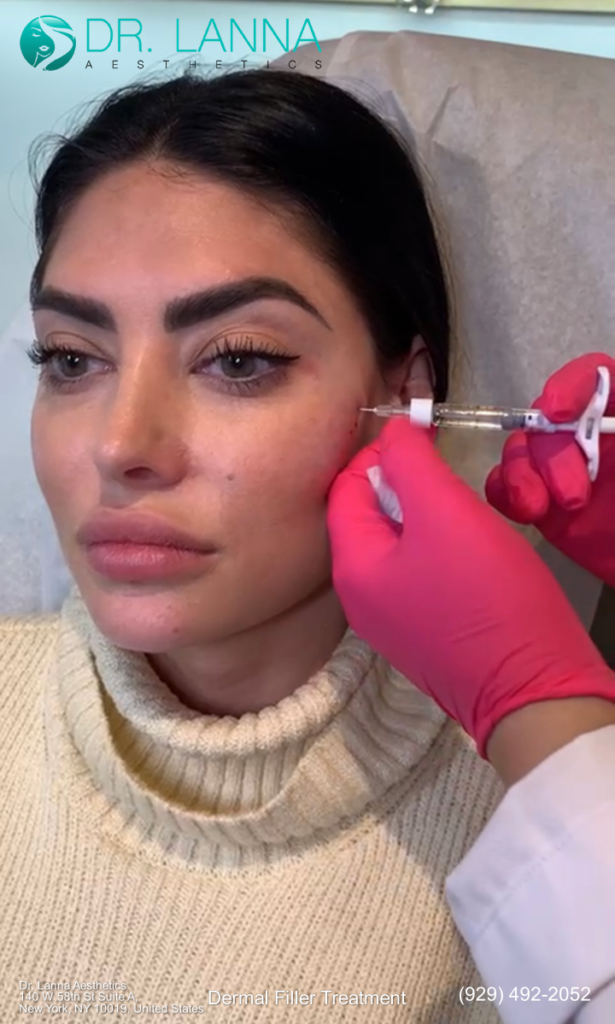 how does dermal filler treatment lift the cheeks