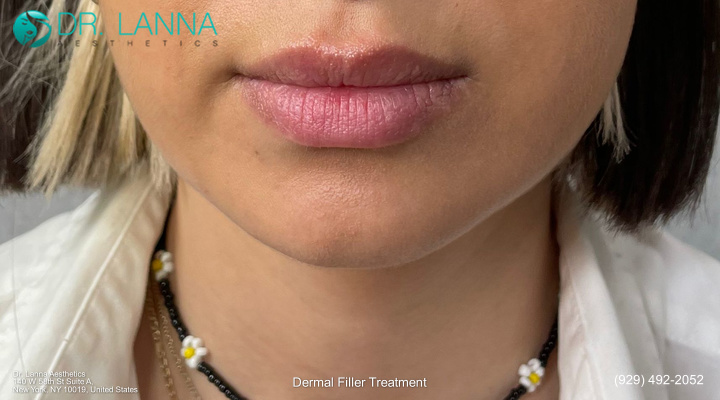 a woman undergoes dermal filler treatment 
