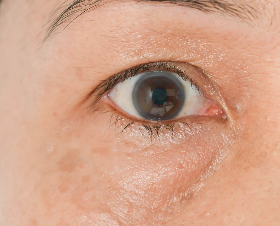 swelling on the under eye after dermal filler procedure