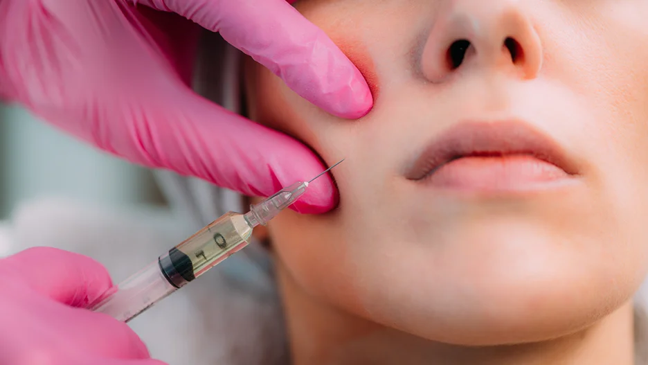 a woman had cheek filler treatment