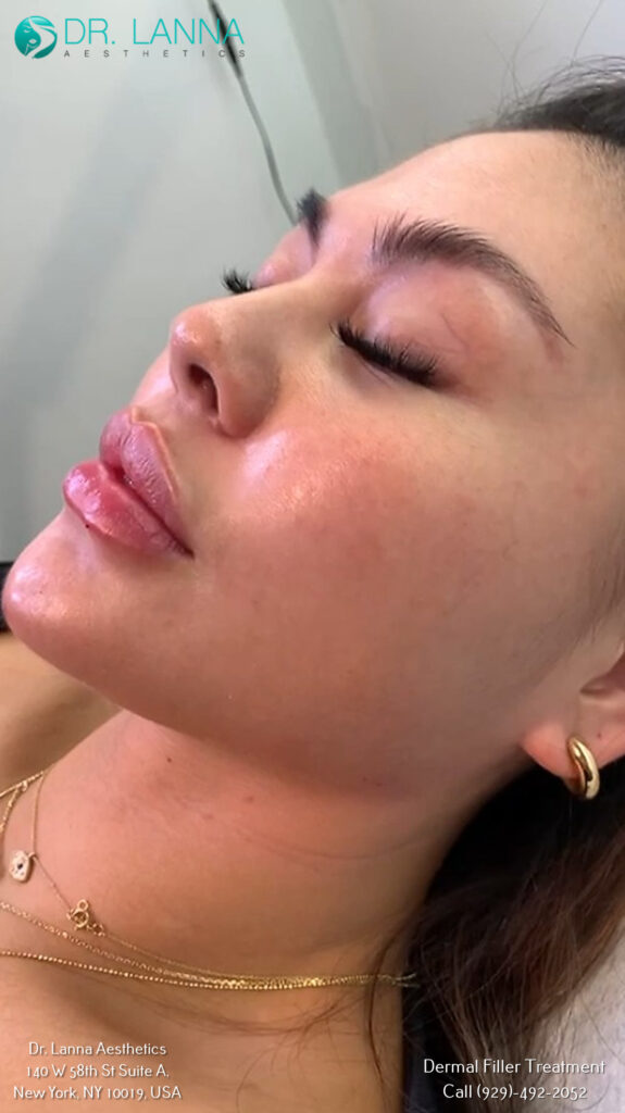 a woman received dermal filler treatment at Dr. Lanna's clinic