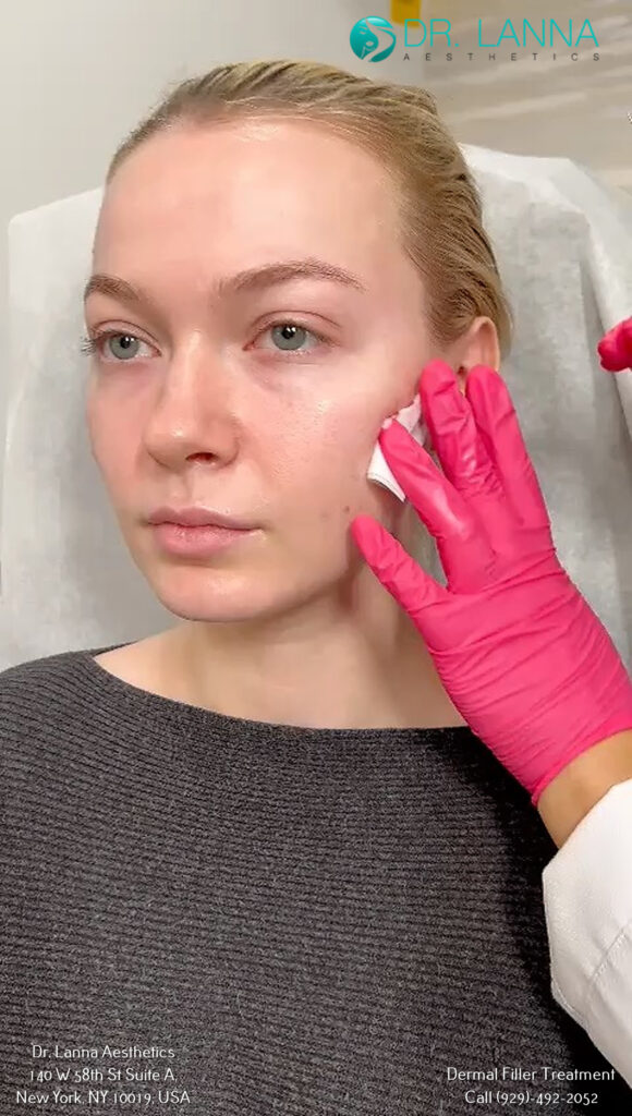 a woman underwent dermal filler procedure at Dr. Lanna's clinic