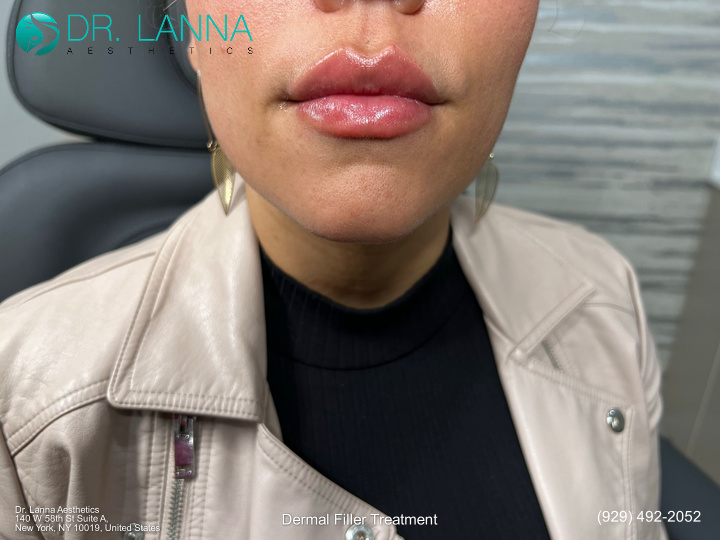 portrait of a woman after getting lip filler at Dr. Lanna Aesthetics' beauty clinic
