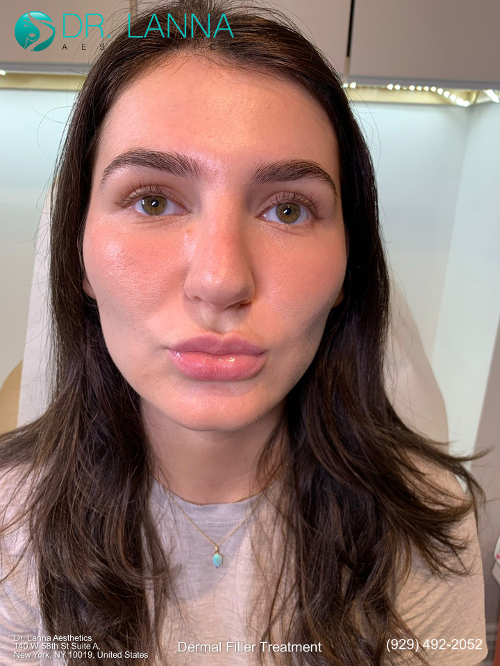 metabolism affect dermal fillers longevity