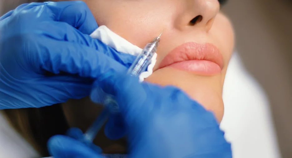 a woman received dermal filler injections on her nasolabial folds