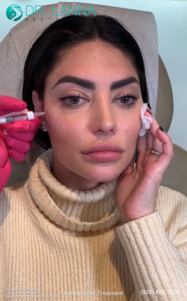 a woman had dermal filler treatment at Dr. Lanna's clinic