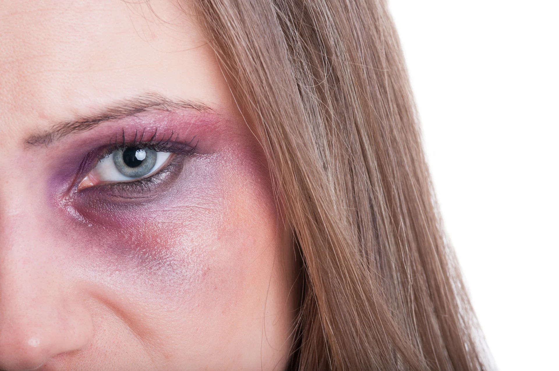 face bruising|woman received dermal filler treatment on her chin at Dr. Lanna Aesthetics' beauty clinic