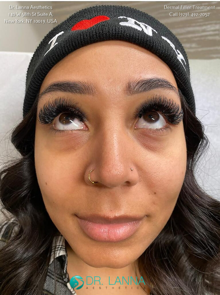 a woman received dermal filler injections at Dr. Lanna's clinic