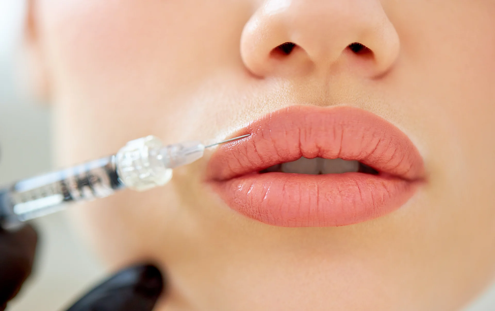 when can vascular occlusions happen after dermal fillers|when can vascular occlusions happen after dermal fillers|