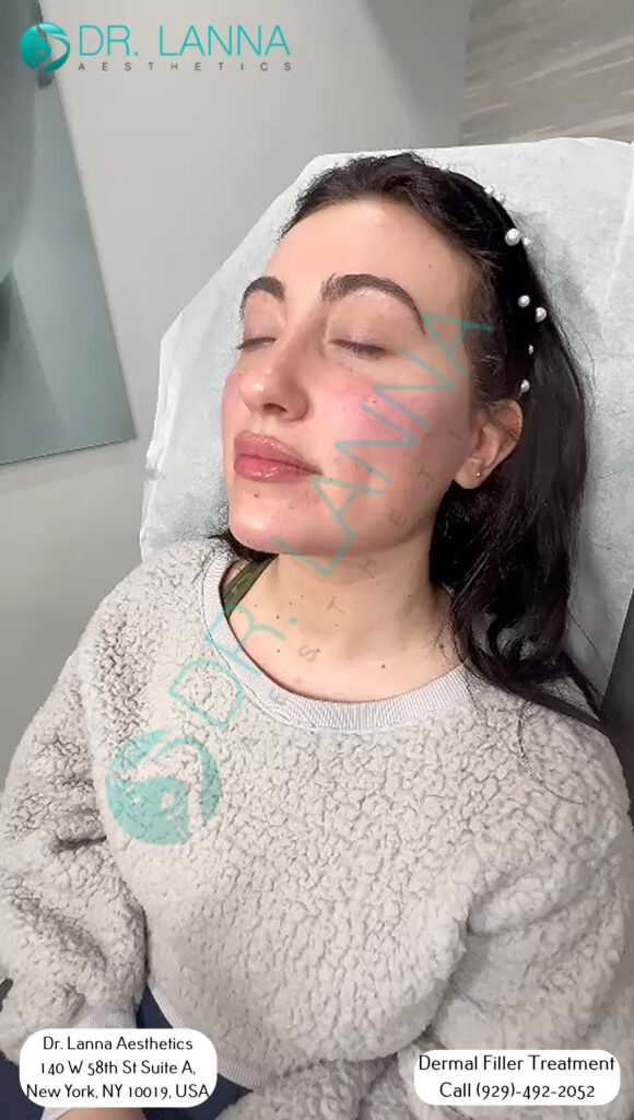 a woman had cheek filler treatment at Dr. Lanna's clinic