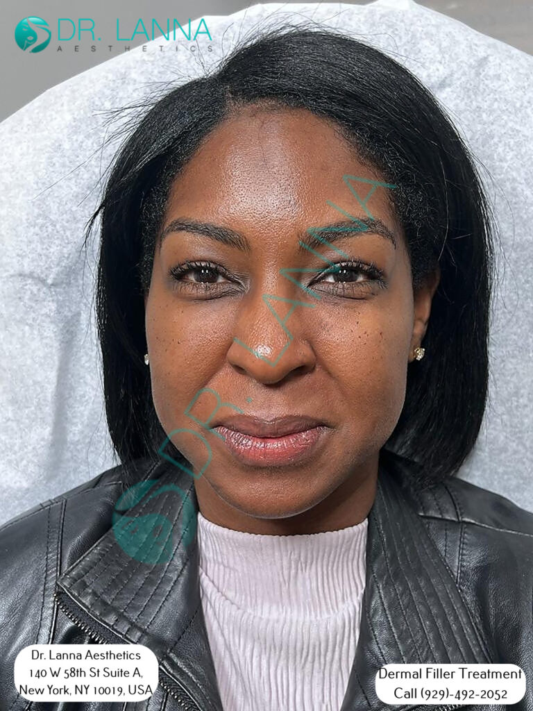 Cheek filler client portrait at Dr. Lanna Aesthetics in New York