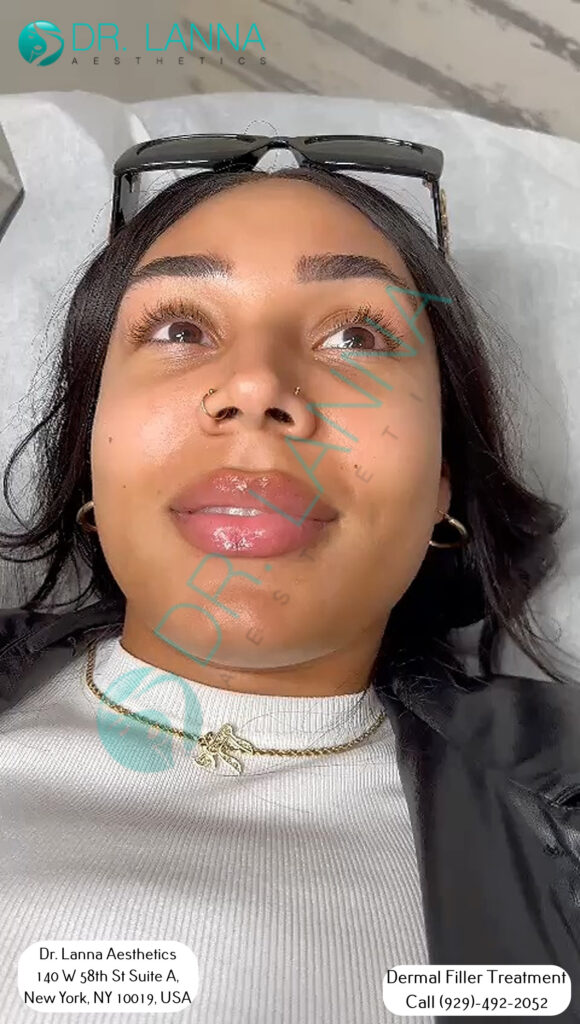 a woman had cheek fillers at Dr. Lanna's clinic