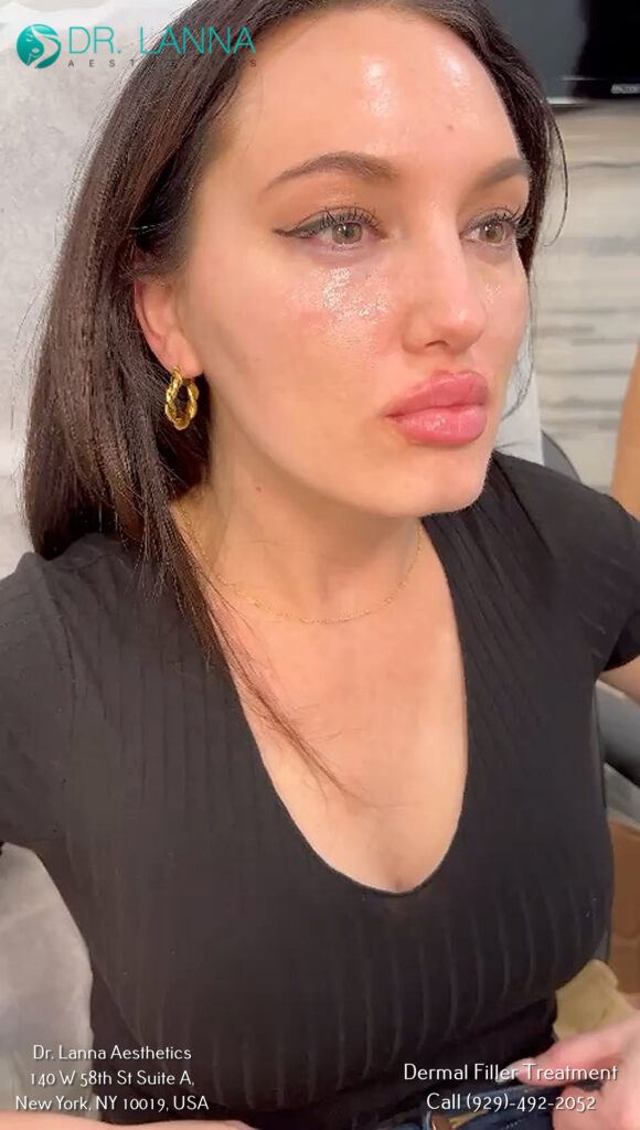 a woman had dermal fillers at Dr. Lanna's clinic