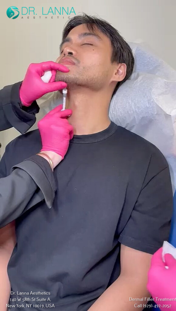 a man received dermal filler treatment on the jawline at Dr. Lanna's clinic