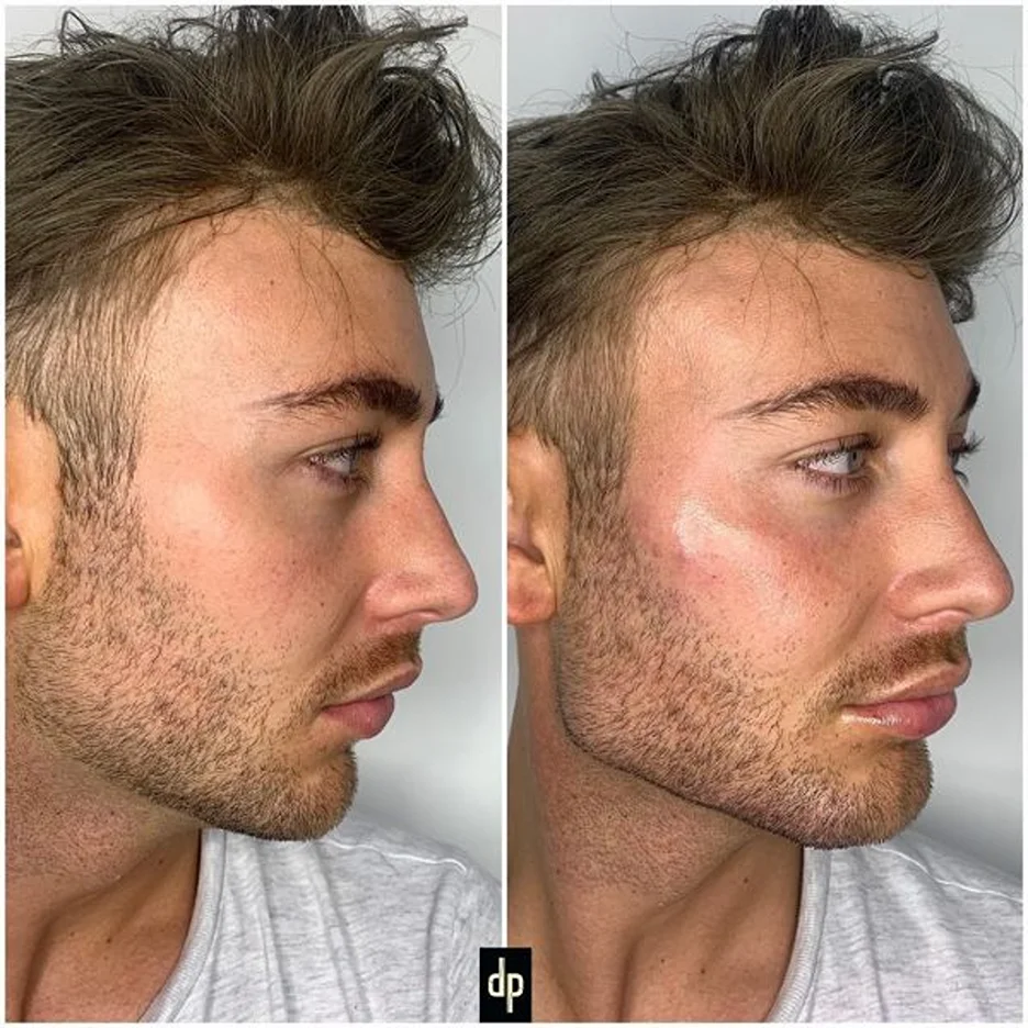 Masculisation-by-Derma-Plus-Aesthetics-600x600