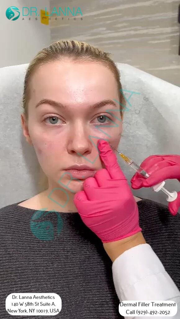a woman had cheek filler injection at Dr. Lanna's clinic