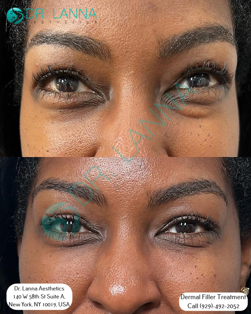 a portrait of before and after cheek filler procedure of a woman at Dr. Lanna's clinic