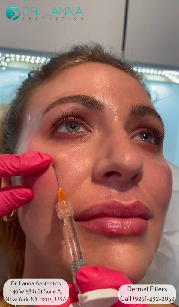 a woman underwent dermal filler procedure at Dr. Lanna's clinic