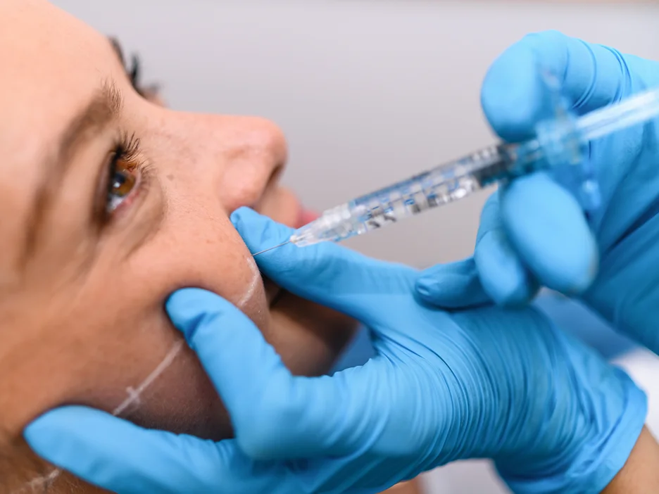 how long for bruising to go away following dermal fillers