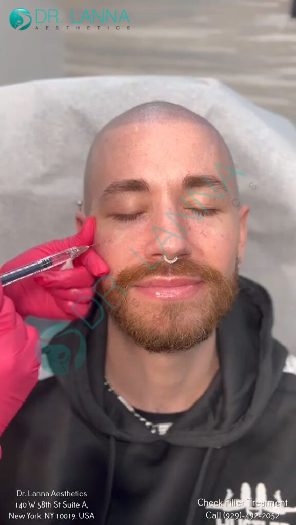 Cheek Filler Treatment at Dr. Lanna Aesthetics