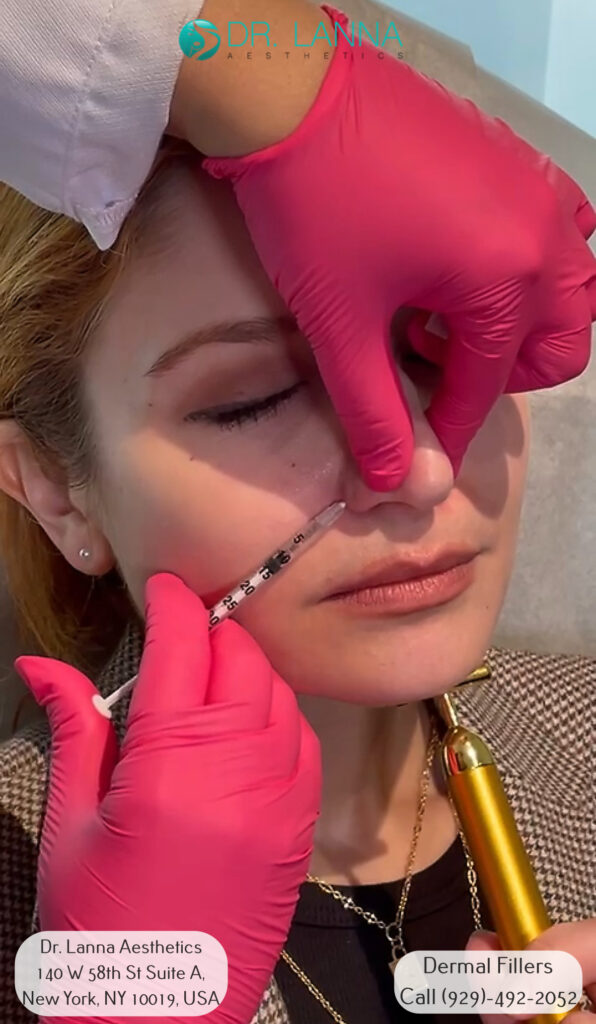 a woman received dermal filler inection on her nose at Dr. Lanna's clinic