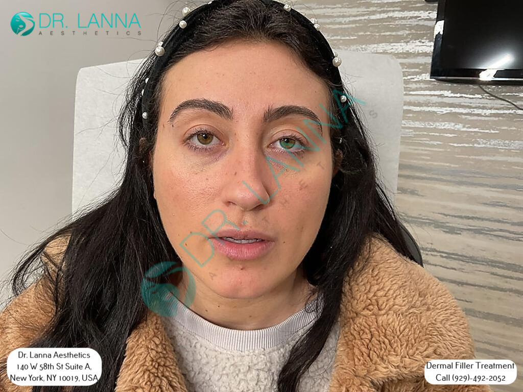 a patient of cheek filler procedure at Dr. Lanna's clinic