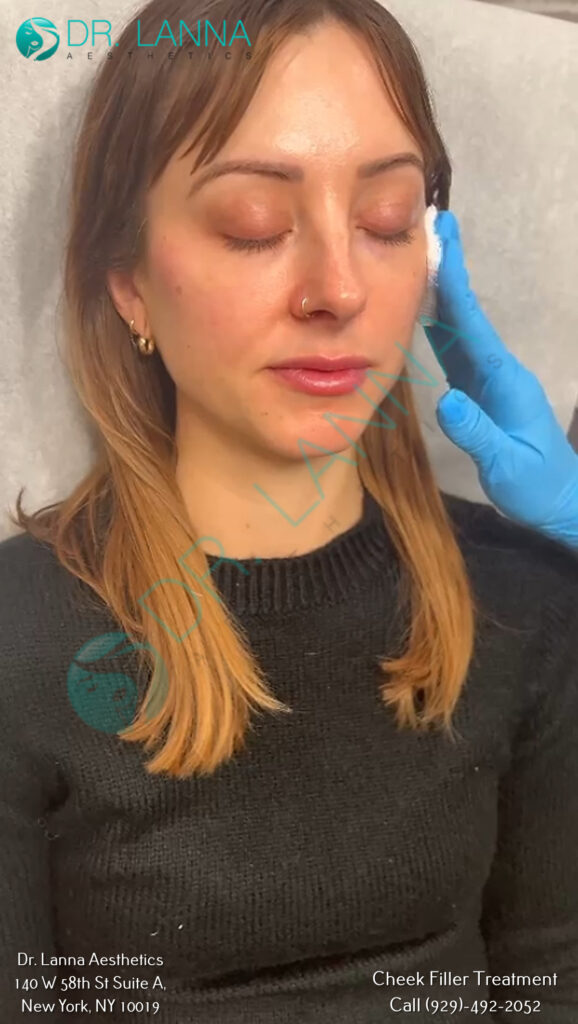Client resting after a cheek filler treatment at Dr. Lanna Aesthetics, NYC